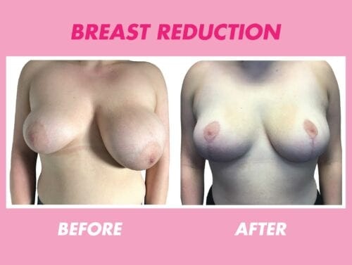 Breast Reduction Before and After - MYA Cosmetic Surgery