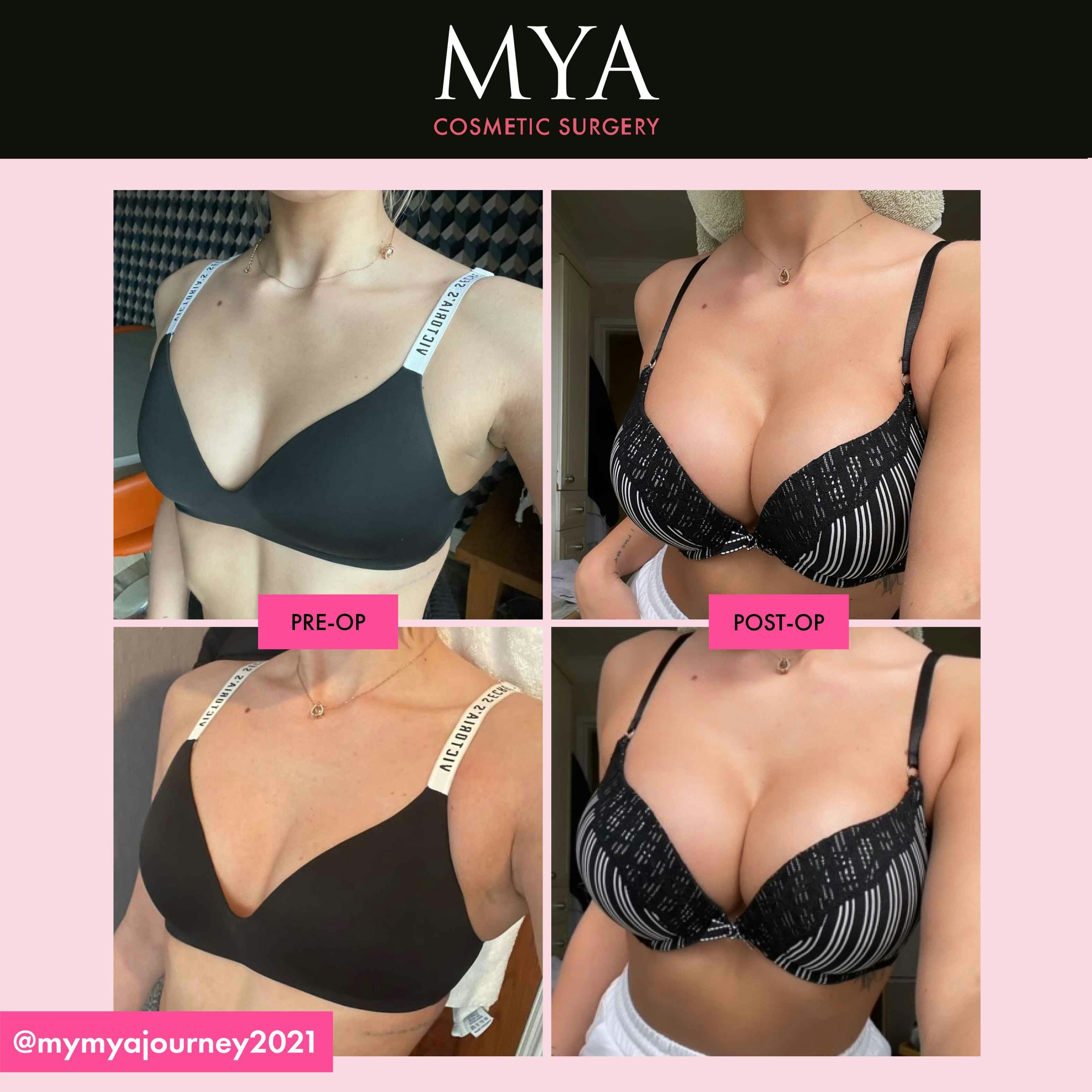 Breast Enlargement Before and After - MYA Cosmetic Surgery