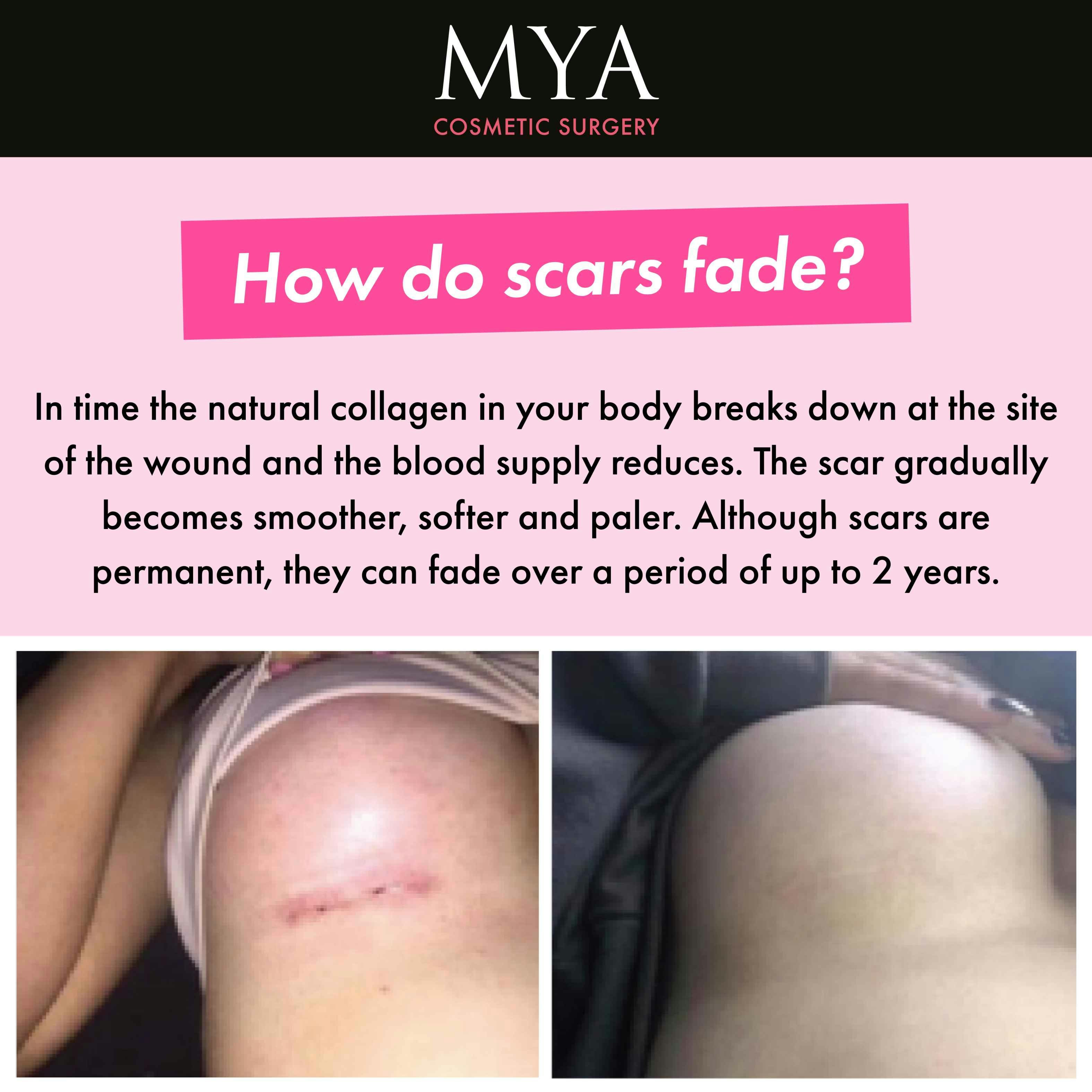 How do scars fade?