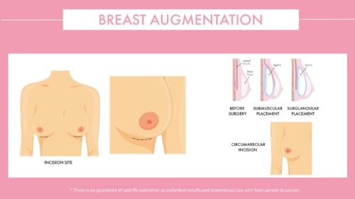 Breast Augmentation Diagram