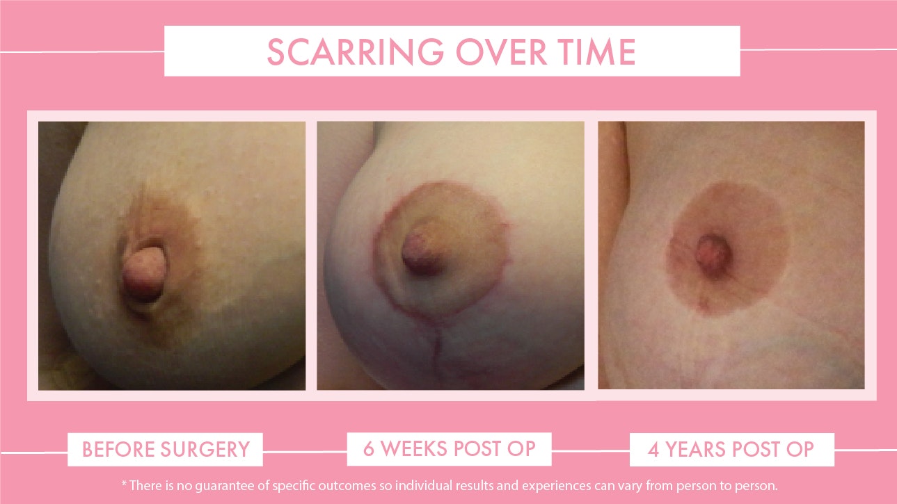 Scarring After Breast Reduction Surgery