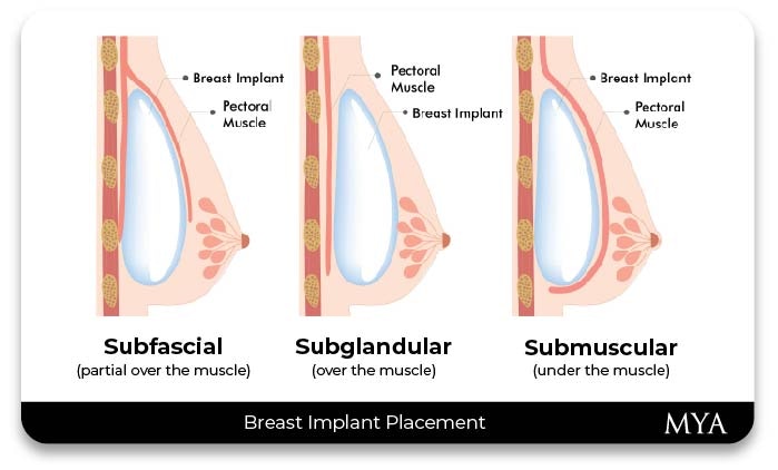 Breast Enlargement Diagram
