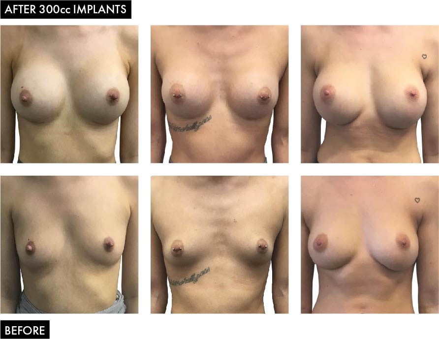 Before and After Breast Enlargement Images - 300cc Implants
