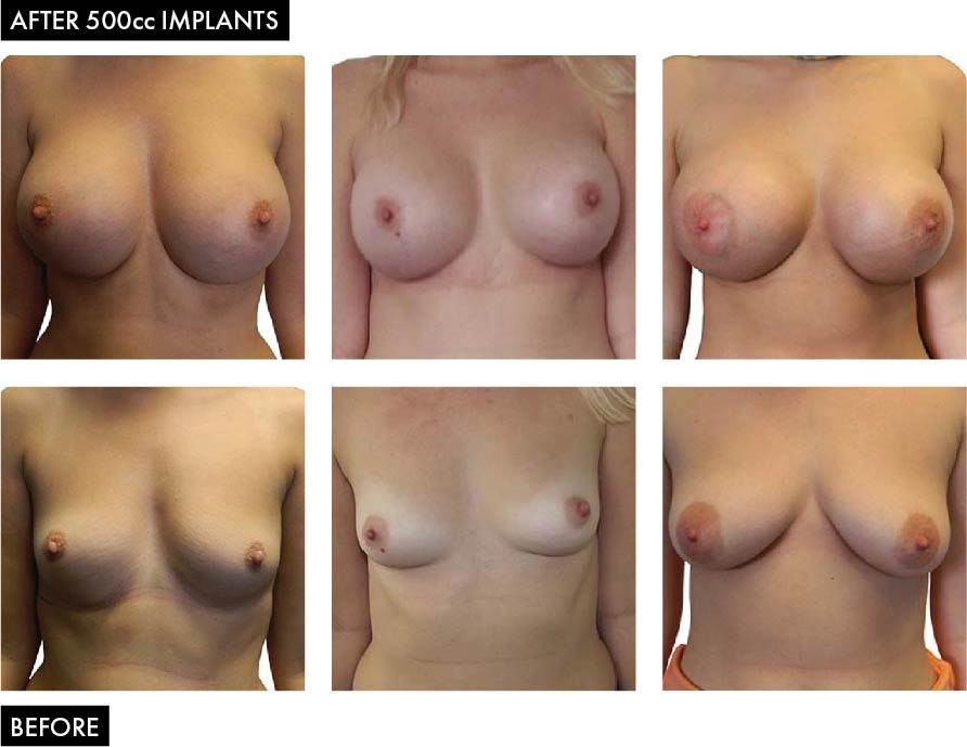Before and After Breast Enlargement Images - 500cc Implants