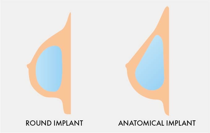 Breast Implant Size Guide MYA Cosmetic Surgery