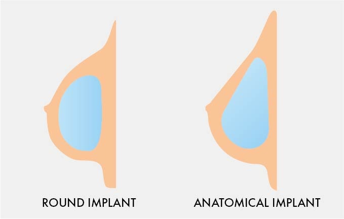 Breast Implant Comparison Images