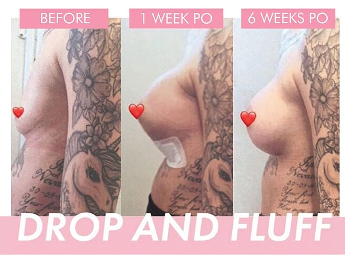 Breast Enlargement Before and After - Drop and Fluff