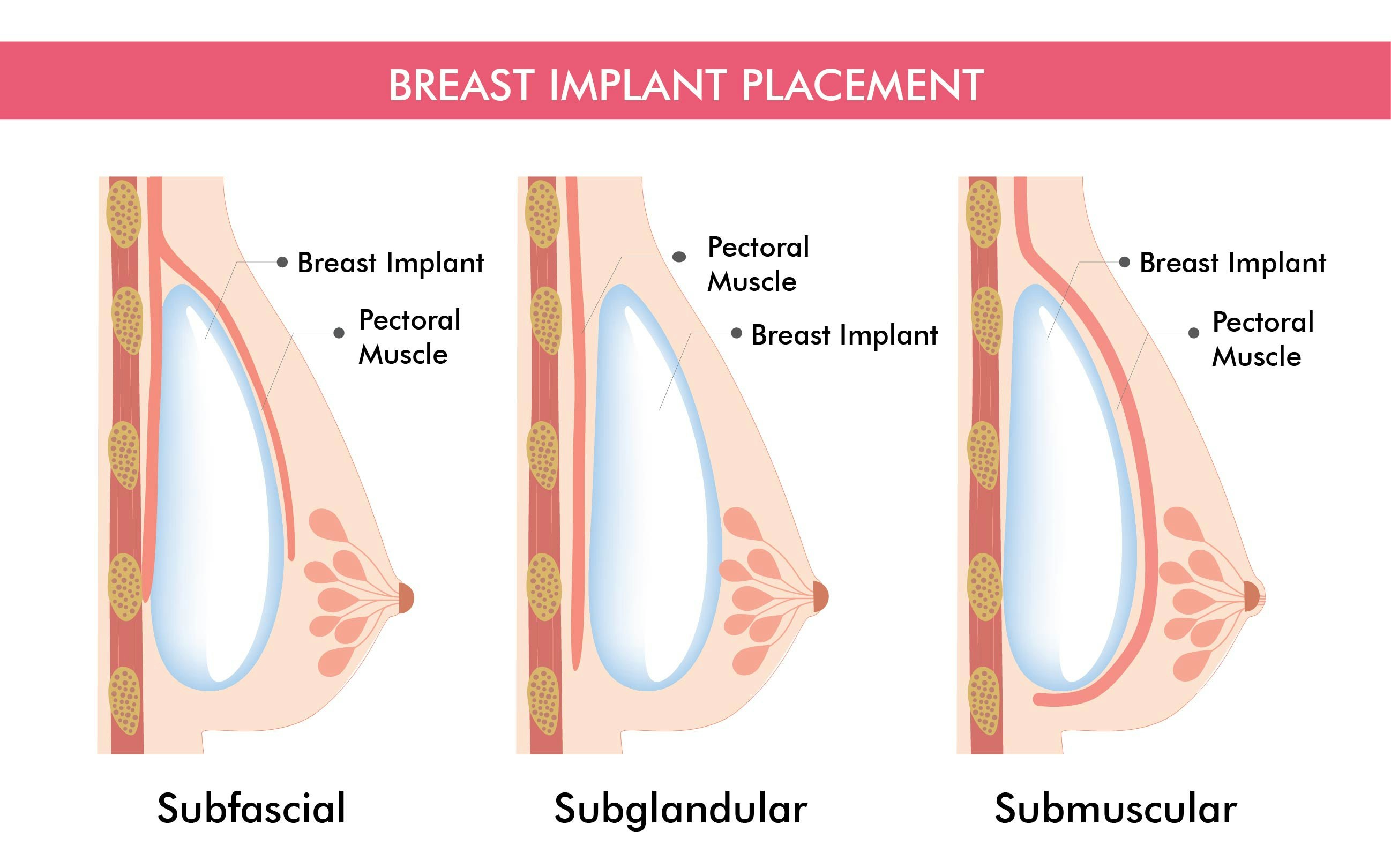 Breast Implant Position: Above or Below the Muscle? - Imagine Plastic  Surgery