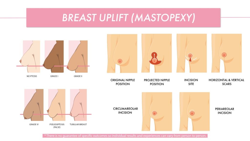 The Most Famous Types of Breast Lift