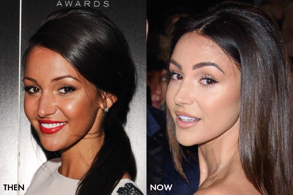 Has Michelle Keegan had Cosmetic Surgery MYA Cosmetic Surgery