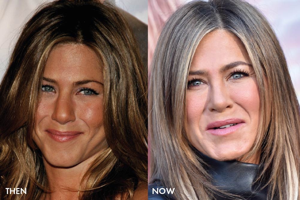 Have the Friends cast had cosmetic surgery? | MYA Cosmetic Surgery