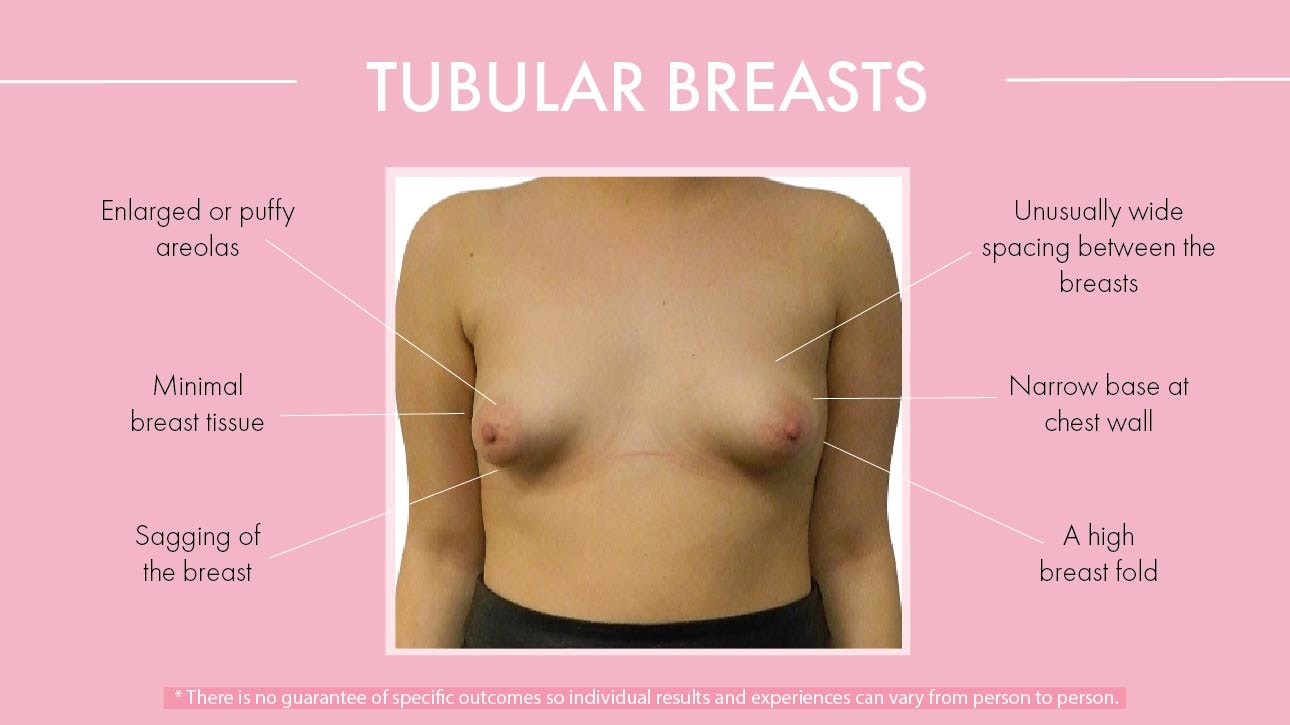 Tuberous Breast Correction  3 Cosmetic Surgery Techniques