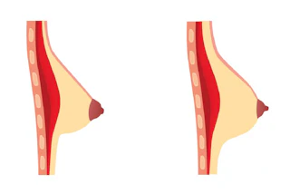 What do tubular breasts look like? | MYA Cosmetic Surgery