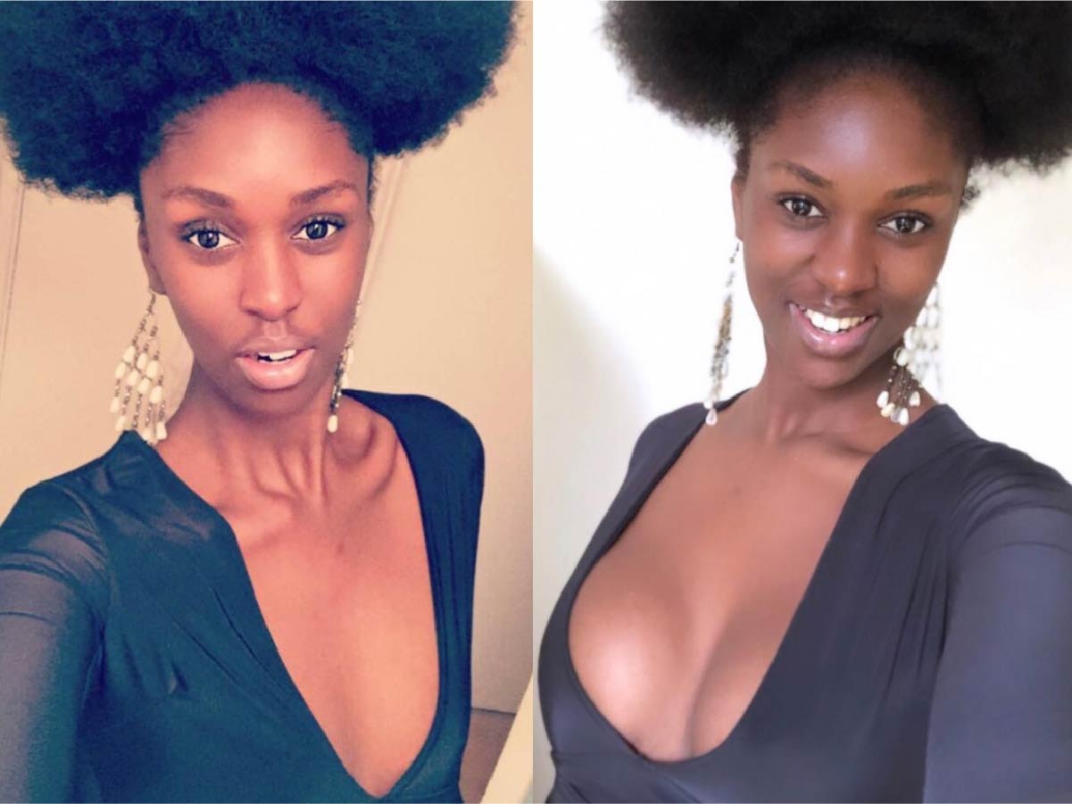 Sherrifa - Cosmetic Surgery at MYA