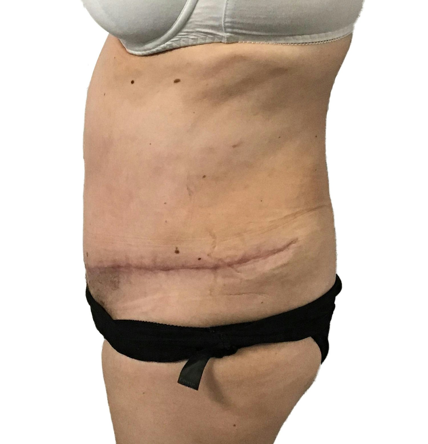 Post Tummy Tuck - MYA Cosmetic Surgery