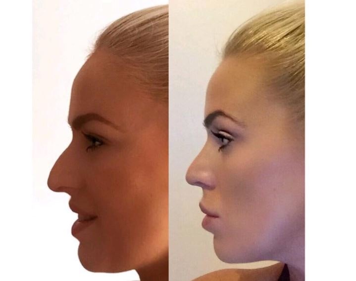 Rhinoplasty Before and After