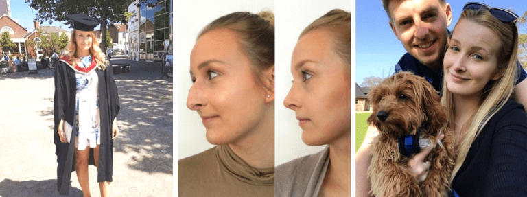 Mya Cosmetic Surgery - Rhinoplasty Before and After