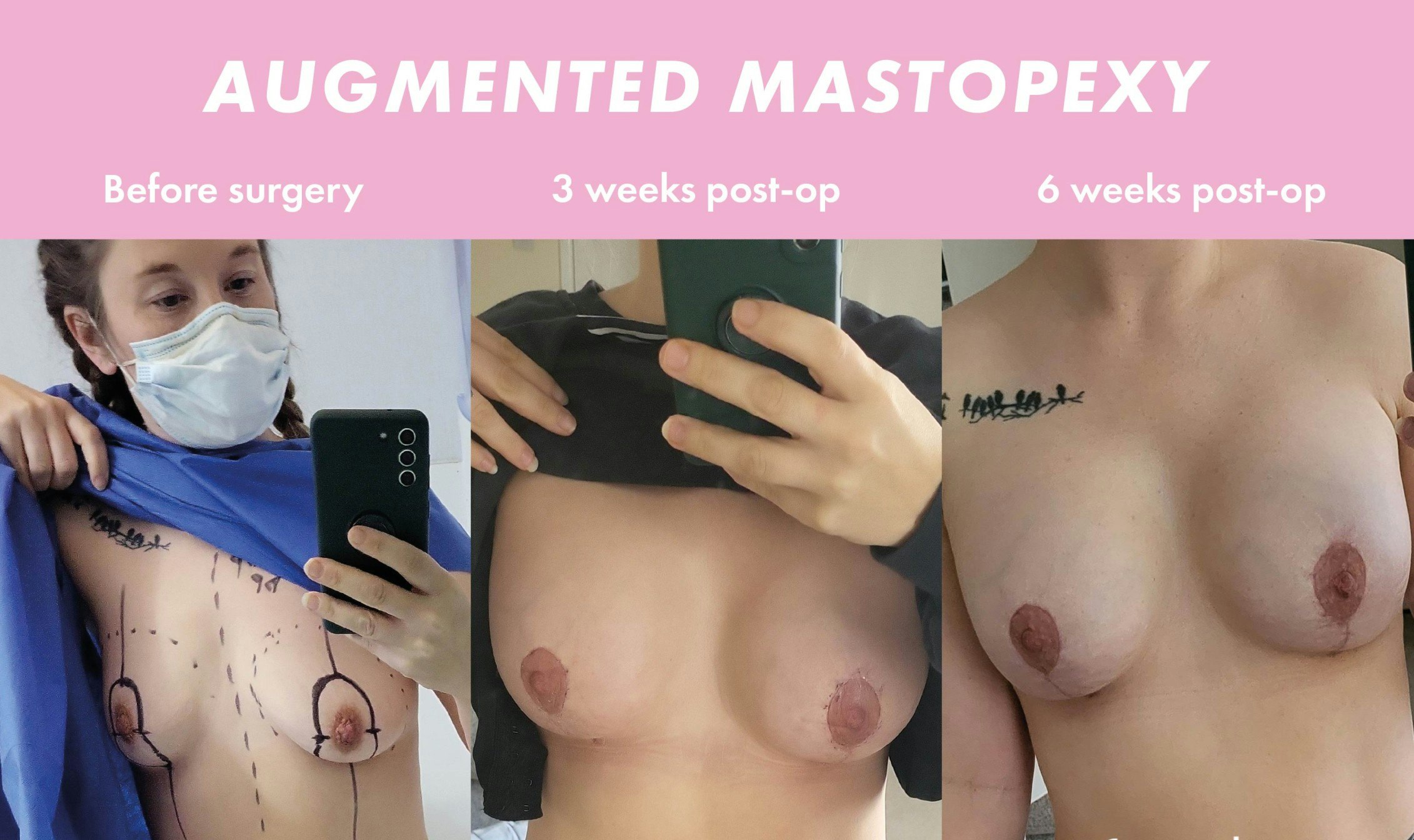 Augmented Mastopexy - Breast Uplifts at MYA