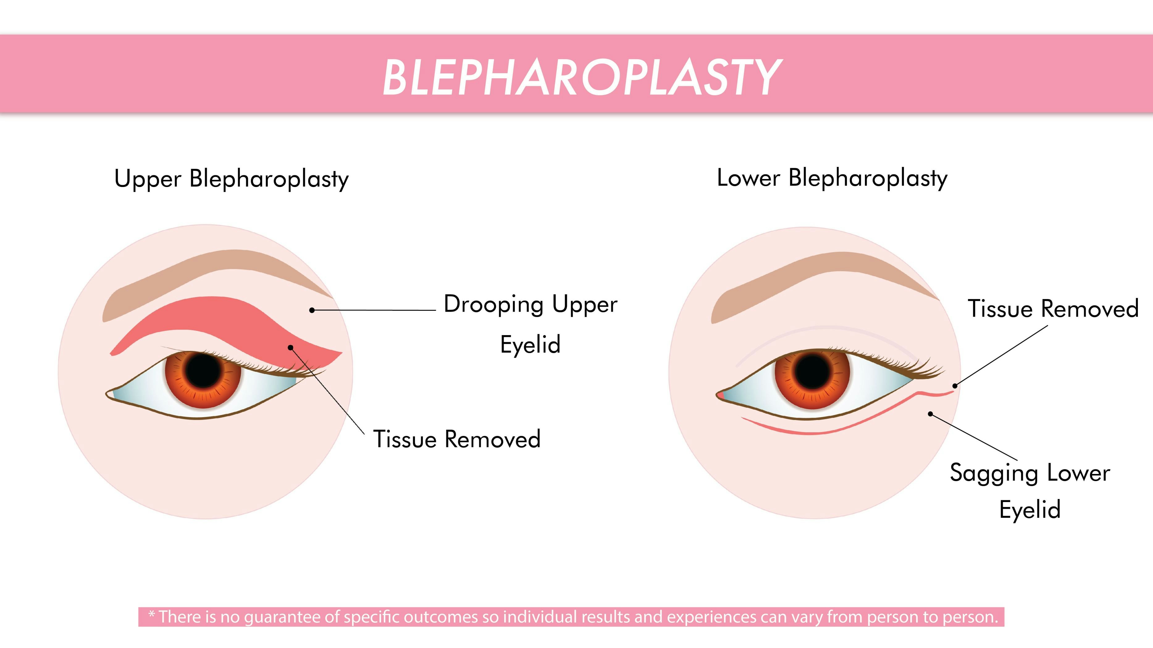 Blepharoplasty surgery diagram