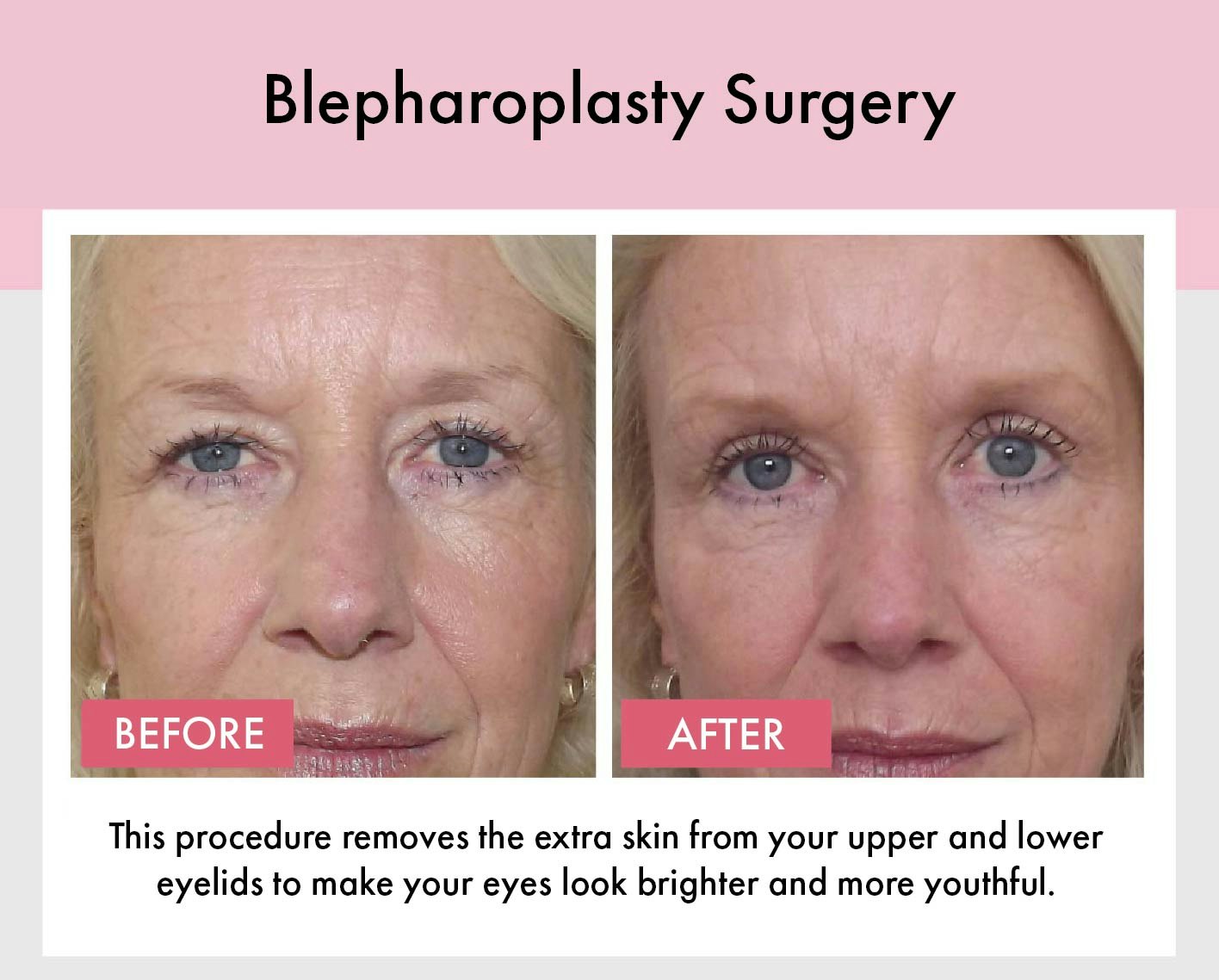 Patient blepharoplasty before and after image