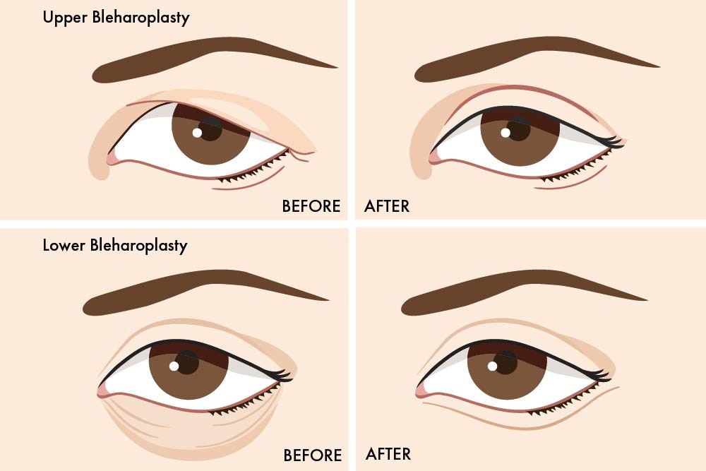 Blepharoplasty at MYA