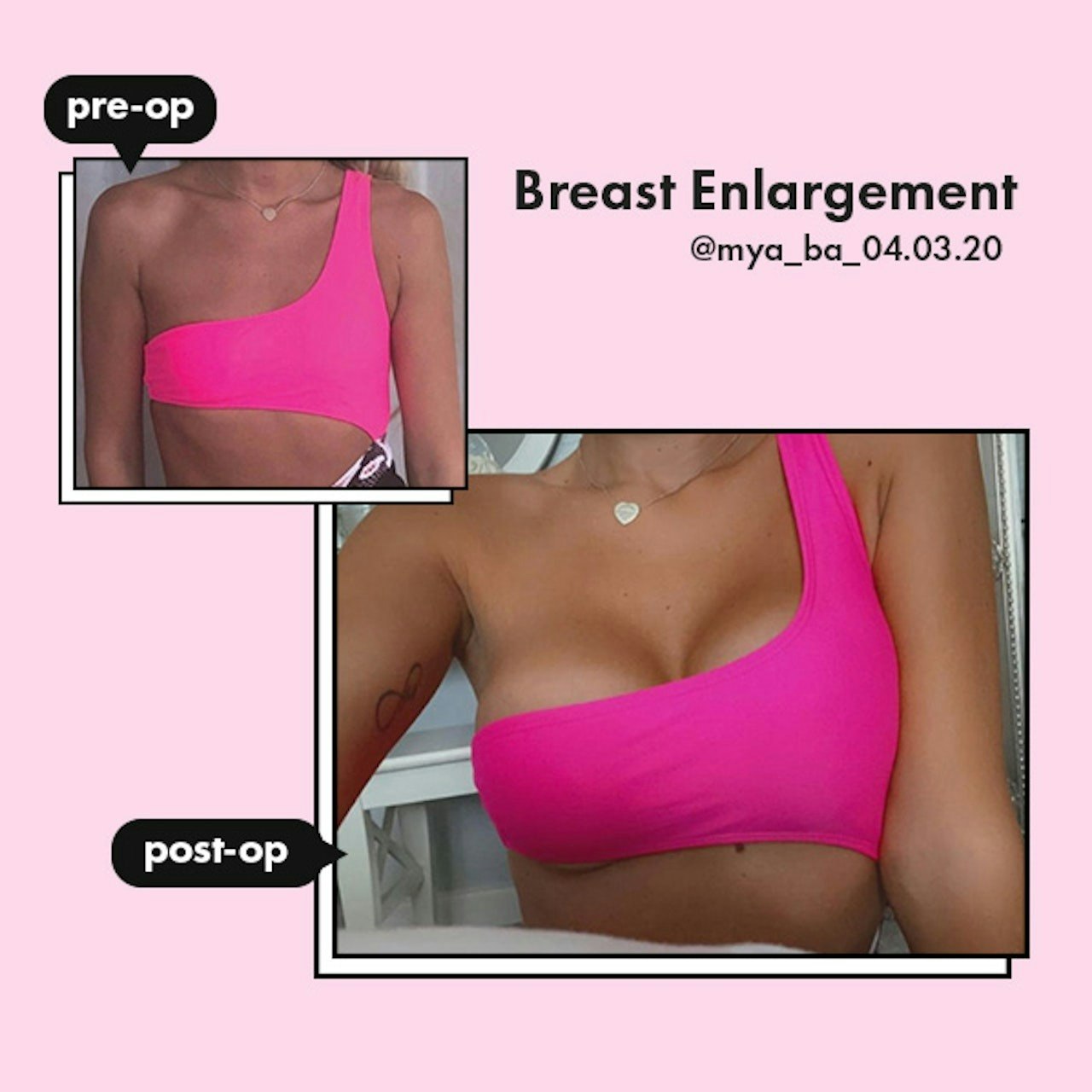 Breast Enlargement London