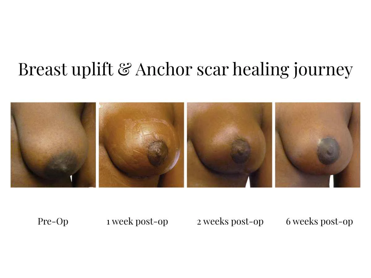 Educational image showing the healing timeline of breast lift surgery scars following a mastopexy procedure. Four close-up photographs of the same breast are displayed side by side, documenting the progression from before surgery through one week, two weeks, and six weeks after surgery. The images demonstrate how the breast shape changes during recovery and how breast lift surgery scars gradually settle as healing progresses. The timeline helps patients understand the typical recovery journey following a breast uplift or breast lift mastopexy procedure.