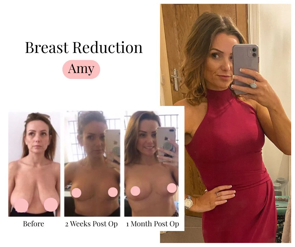 Collage showing a breast reduction before and after patient journey. On the left are three progress photographs of the same woman: a pre-operative image, a photograph taken two weeks after breast reduction surgery, and another taken one month after surgery. The images show the gradual healing process and a reduction in breast size. On the right, the woman is smiling while taking a mirror selfie in a fitted burgundy dress, standing confidently with one hand on her hip. The collage highlights breast reduction recovery, healing progress, and increased confidence following breast reduction surgery.