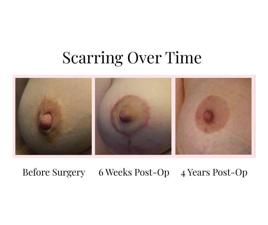Educational image showing how breast reduction scars can change and fade over time following breast reduction surgery. Three close-up photographs of the breast are displayed side by side. The first image shows the breast before surgery. The second image shows healing and visible breast reduction scars around the nipple and lower breast at six weeks post-operative. The third image, taken four years after breast reduction surgery, shows the scars appearing significantly softer and less noticeable, illustrating the long-term healing process.