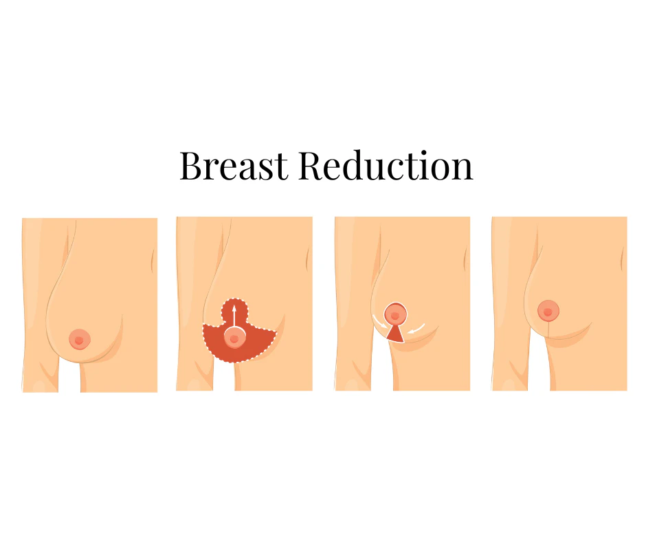 Medical illustration showing the stages of a breast reduction procedure. The four-panel diagram begins with a side view of a larger breast, followed by a visual representation of excess breast tissue and skin being removed. The next panel shows the breast being reshaped and the nipple repositioned higher on the breast. The final panel shows the completed breast reduction surgery result, with a smaller, more lifted breast shape and improved proportion. The illustration explains how breast reduction surgery reduces breast size while creating a natural-looking contour.