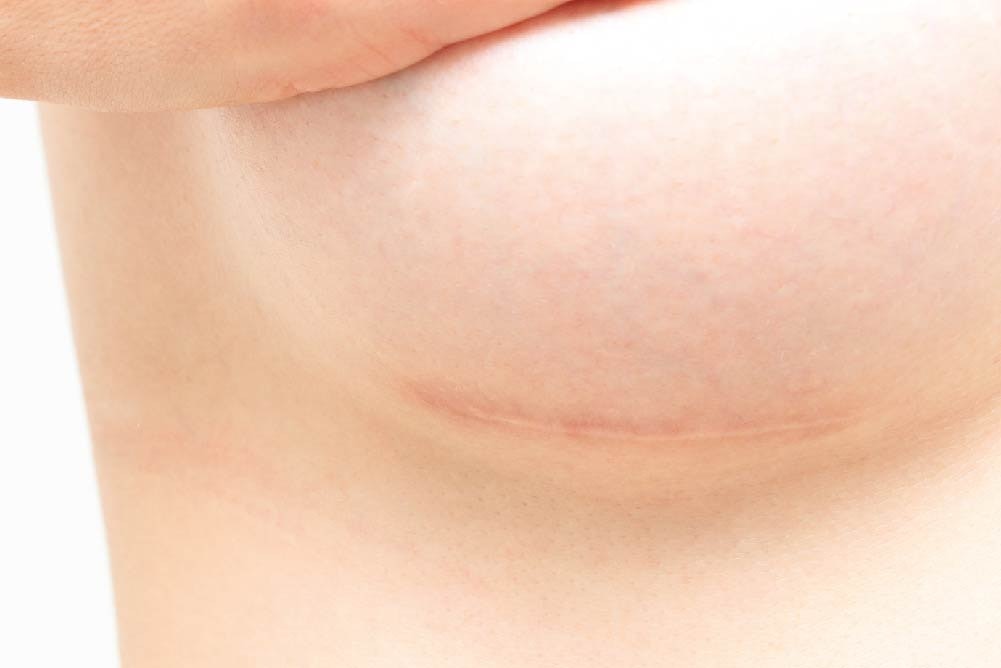 Breast Augmentation Scarring