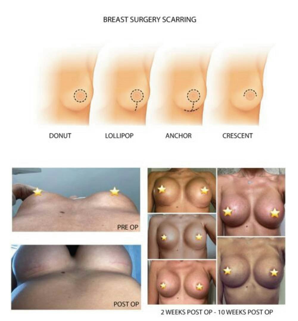 Breast Surgery Scarring