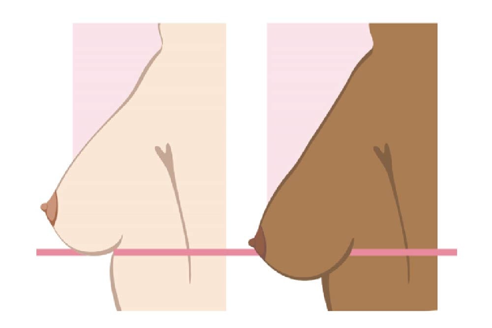 Breast Uplift vs Breast Enlargement