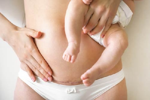 C-Section Scar