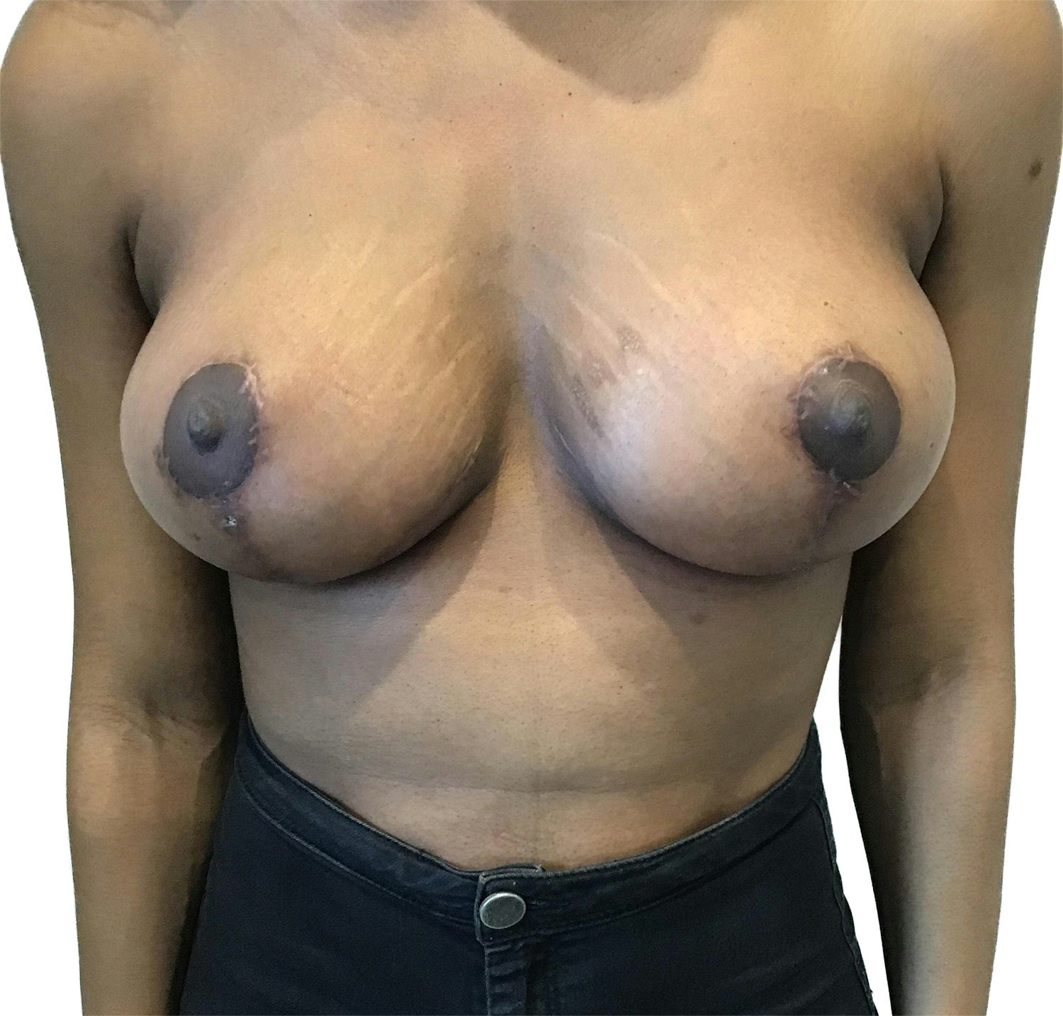 Breast Uplift Before and After