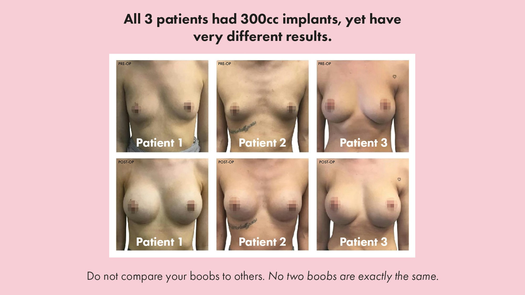300cc Breast Implant Before and After