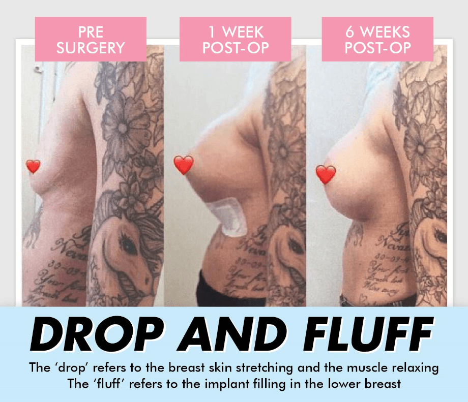 Breast Implants - Drop and Fluff