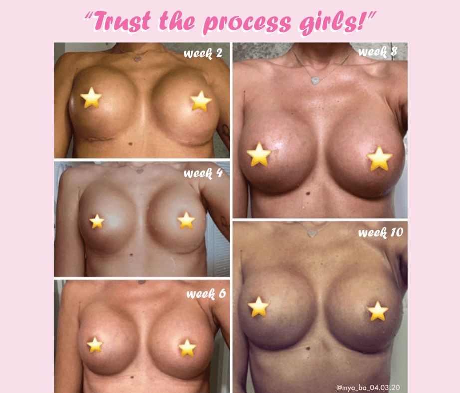 Breast Implant Results
