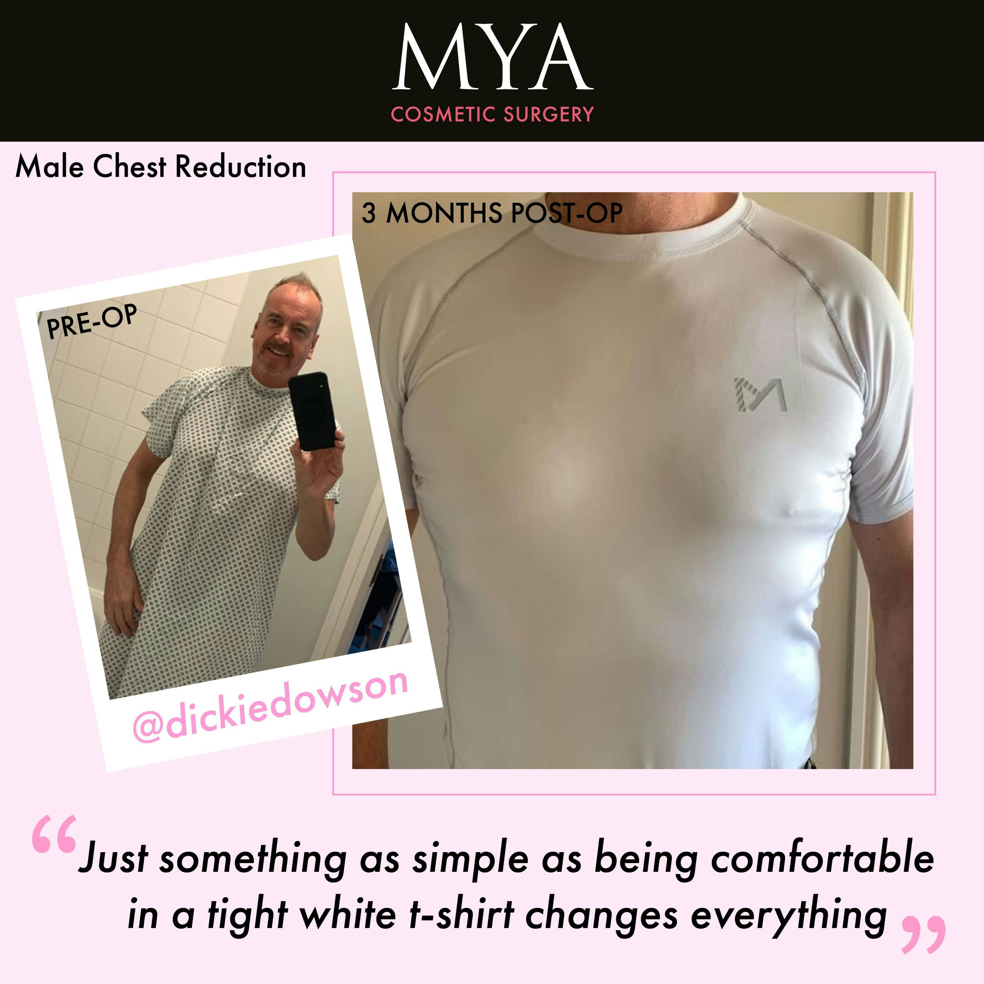Male Chest Reduction Before and After