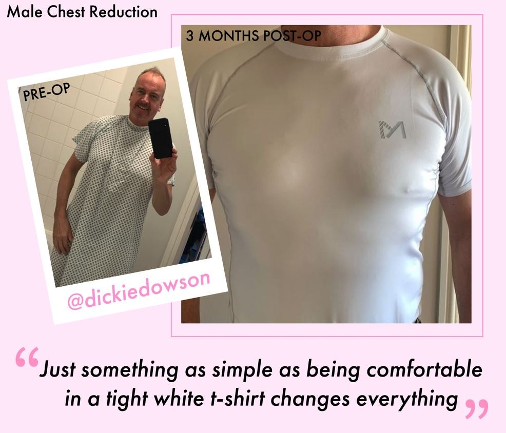 Male Chest Reduction Before and After
