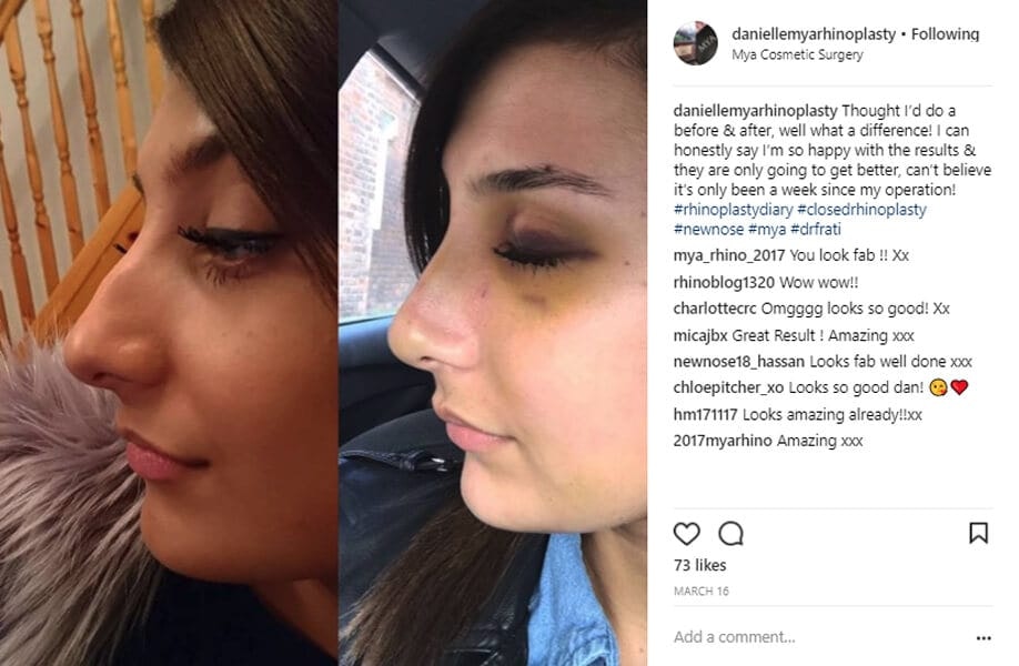 daniellemyarhinoplasty Instagram Journey