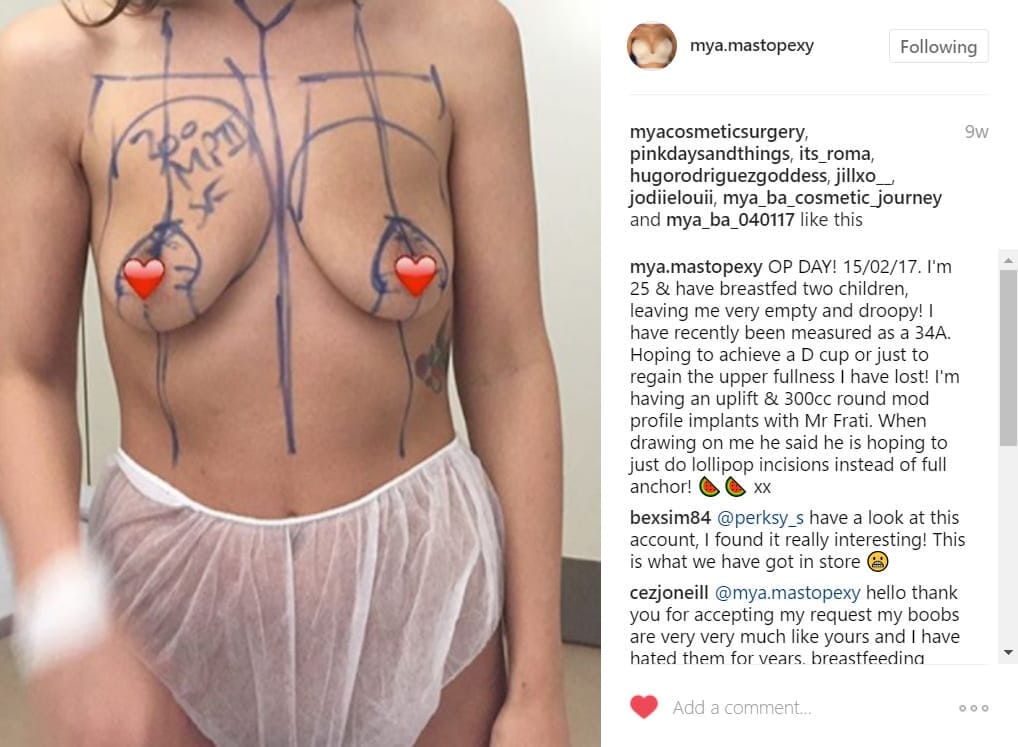 mya-mastopexy Instagram Journey