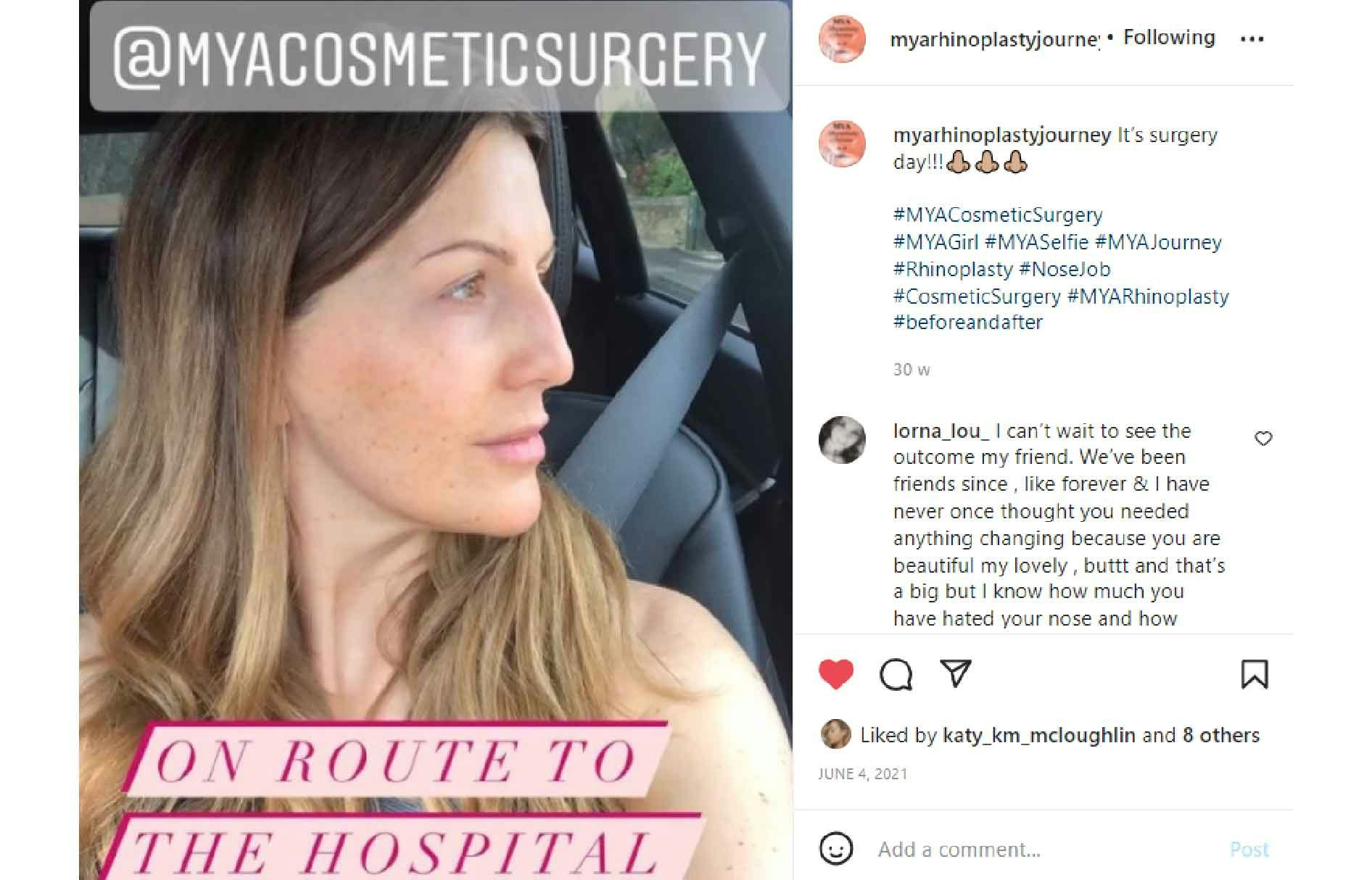 myarhinoplastyjourney Instagram Journey