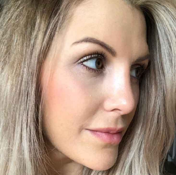myarhinoplastyjourney Instagram Journey