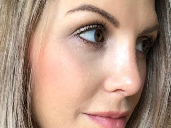 myarhinoplastyjourney Instagram Journey