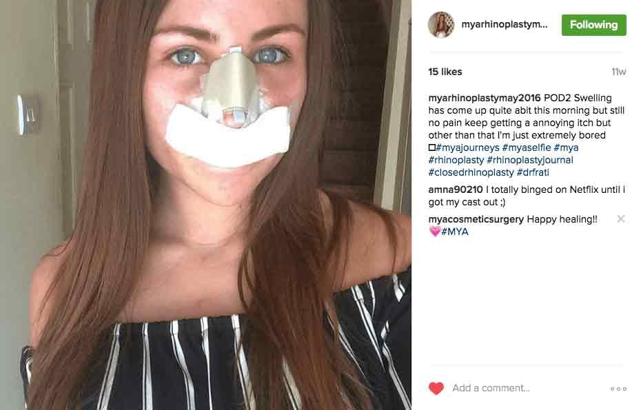 myrhinoplastymay2016 Instagram Journey