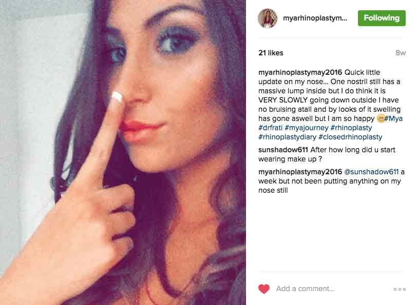 myrhinoplastymay2016 Instagram Journey