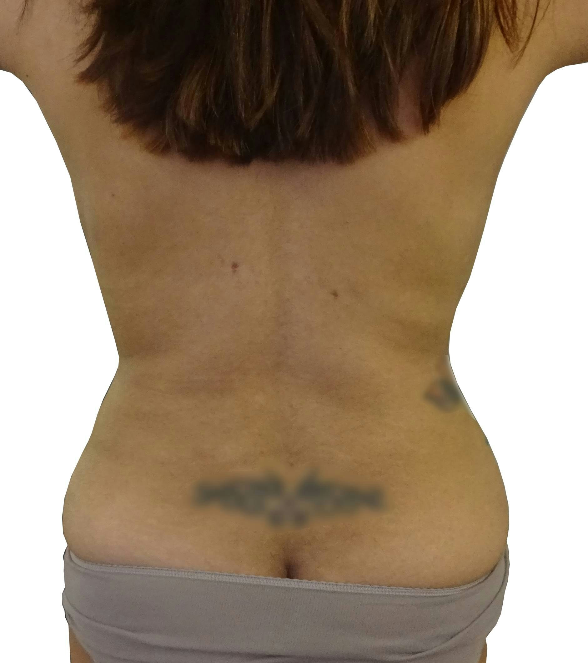 Liposuction - Before and Afters