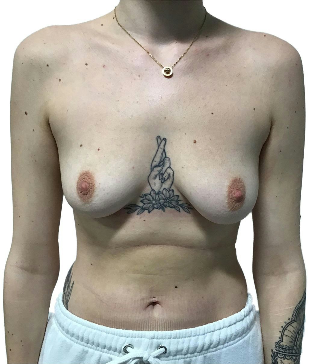 Breast Enlargement - MYA