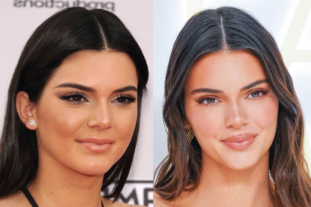 Has Kendall Jenner had a boob job MYA Cosmetic Surgery